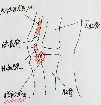 膝の痛み　オスグッド　
