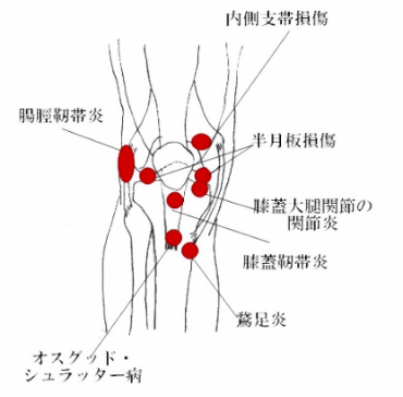 膝の痛み