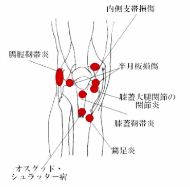 膝の痛み　