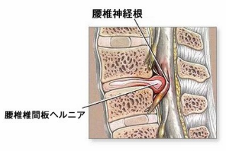 腰椎椎間板ヘルニア