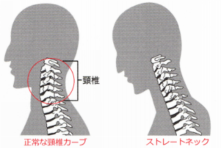 ストレートネック