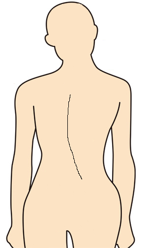 腰椎椎間板ヘルニア