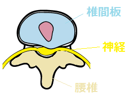 腰椎椎間板ヘルニア